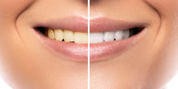 Esthétique du sourire